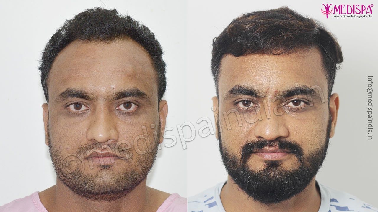 hair transplant cost in dubai