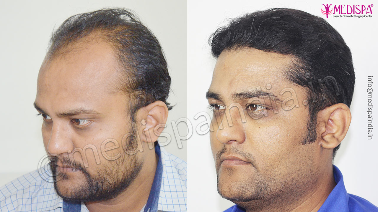 hair transplant cost in bangladesh