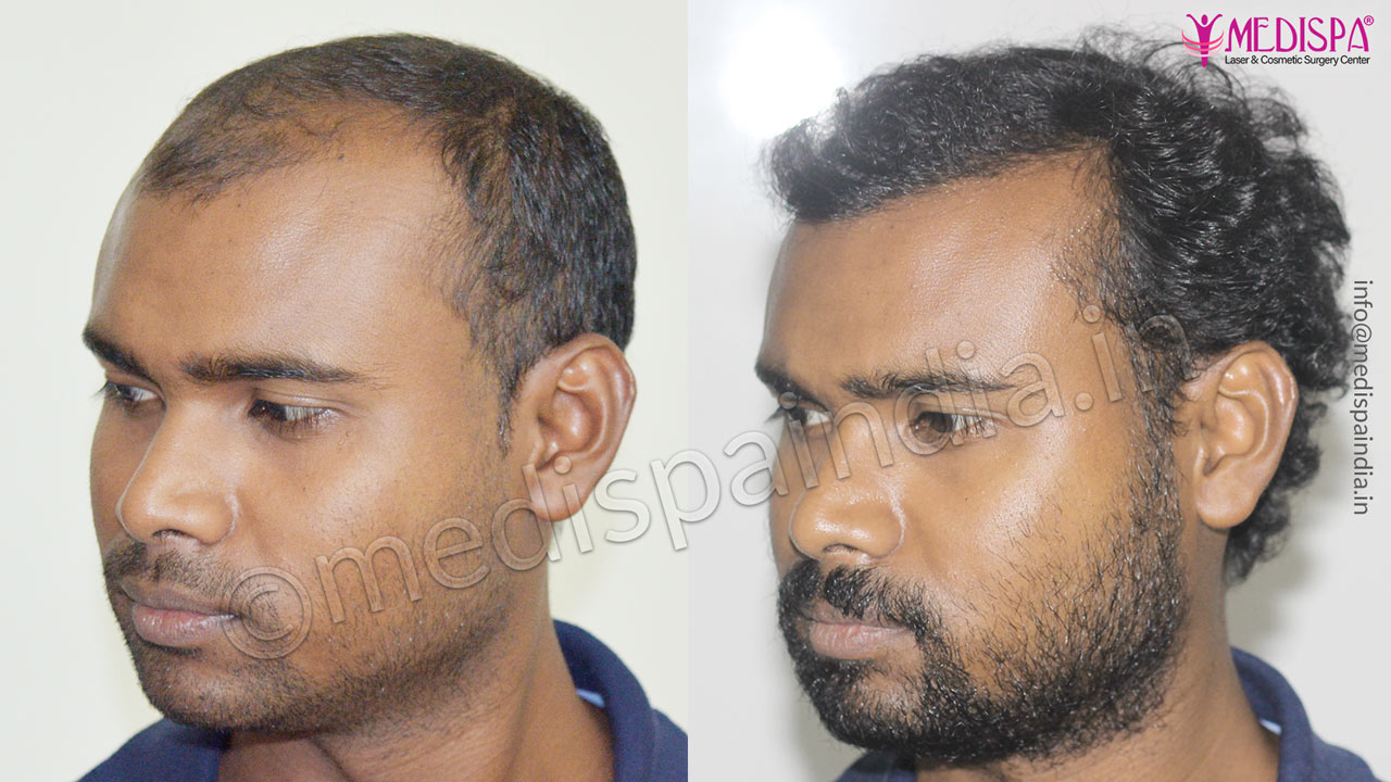 hair transplant cost in bengaluru