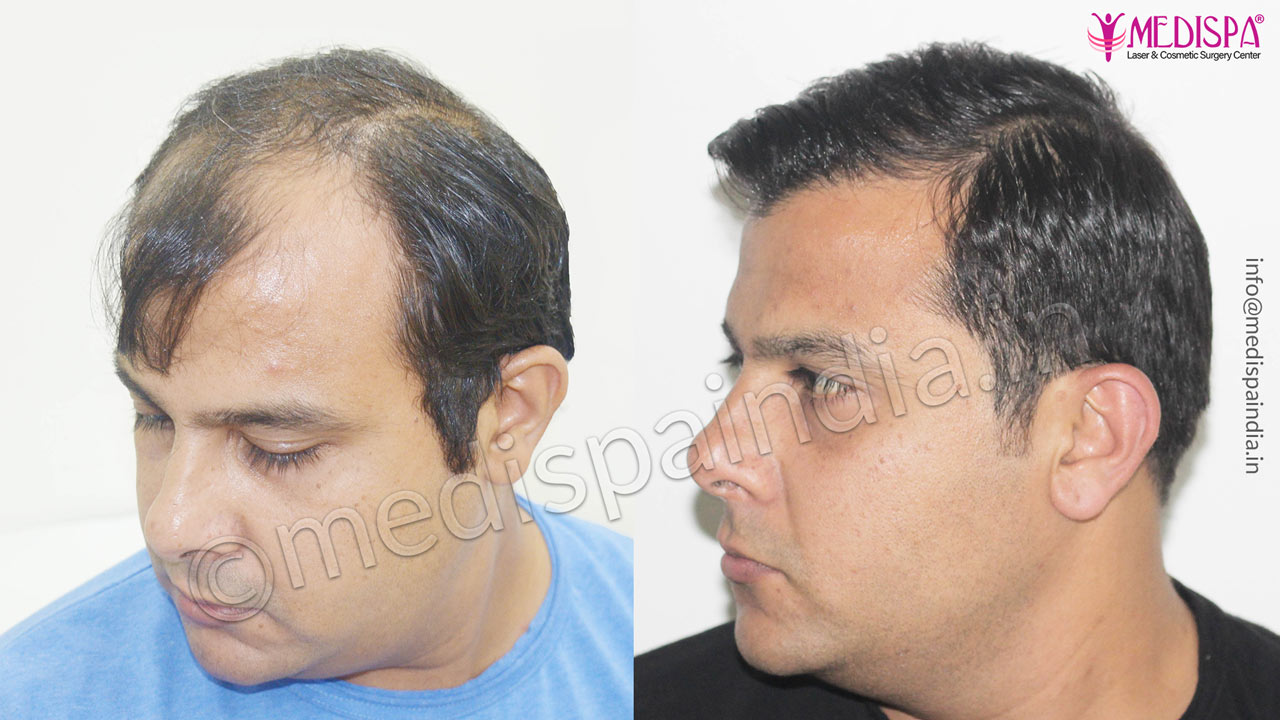 hair transplant cost in bhubhneshwar