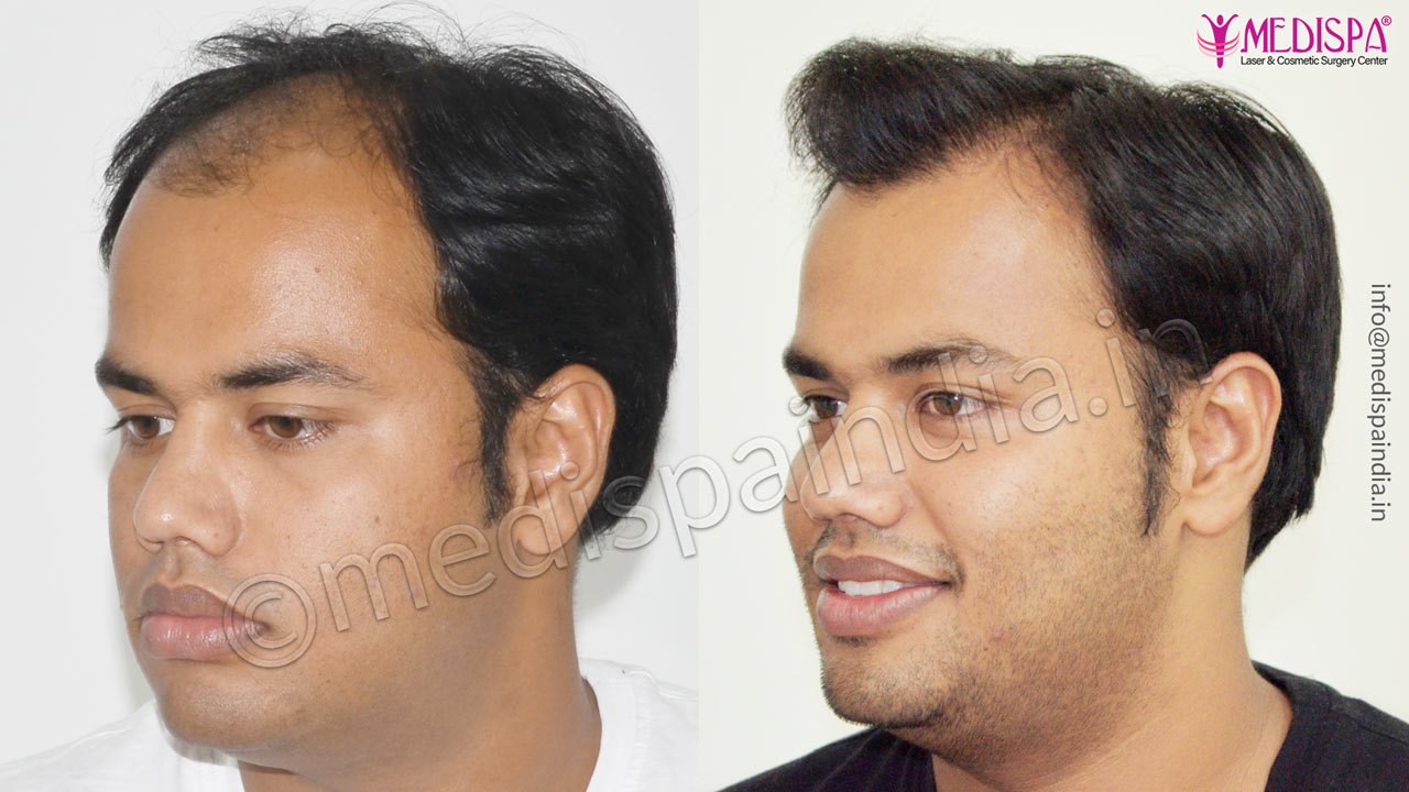 hair transplant cost in bikaner rajasthan