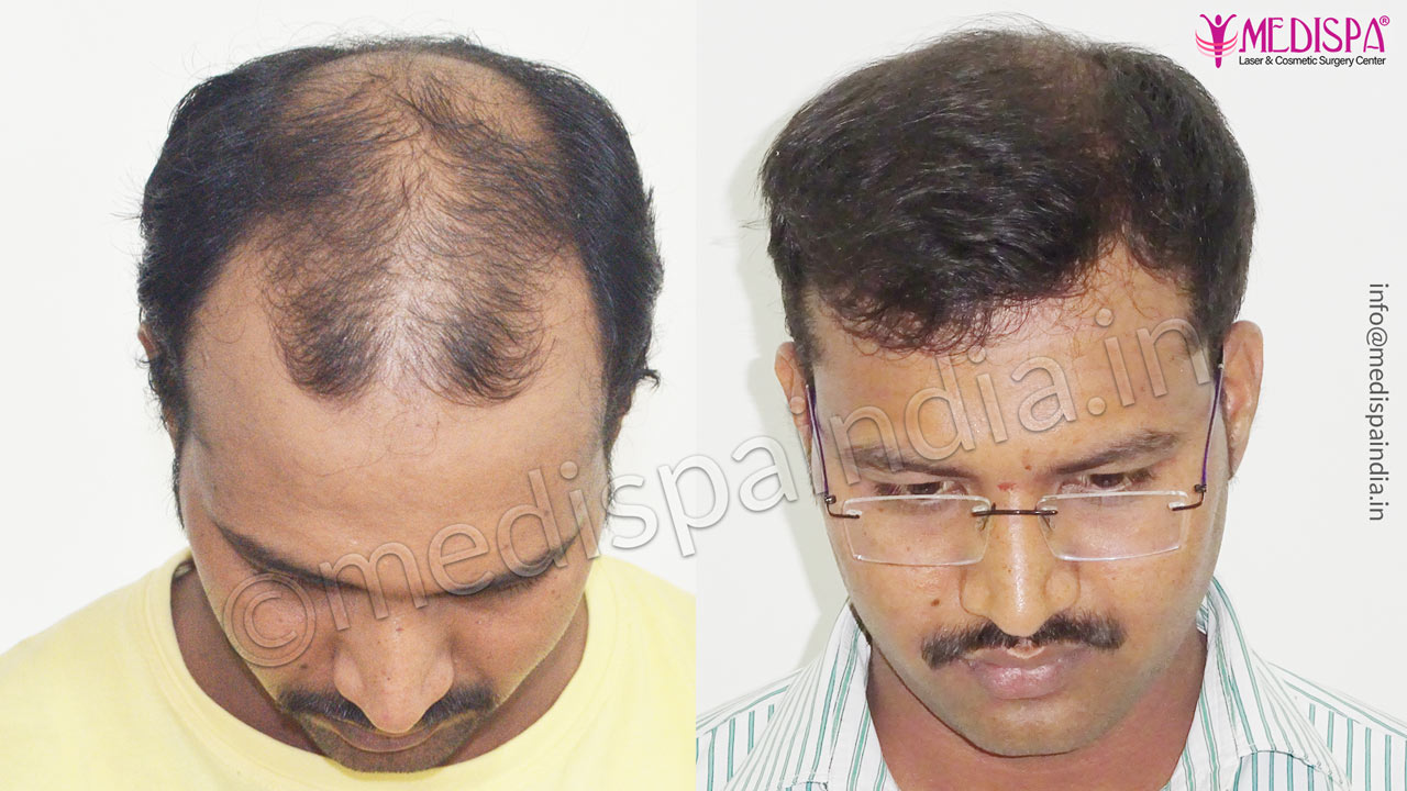 hair transplant cost in cananda