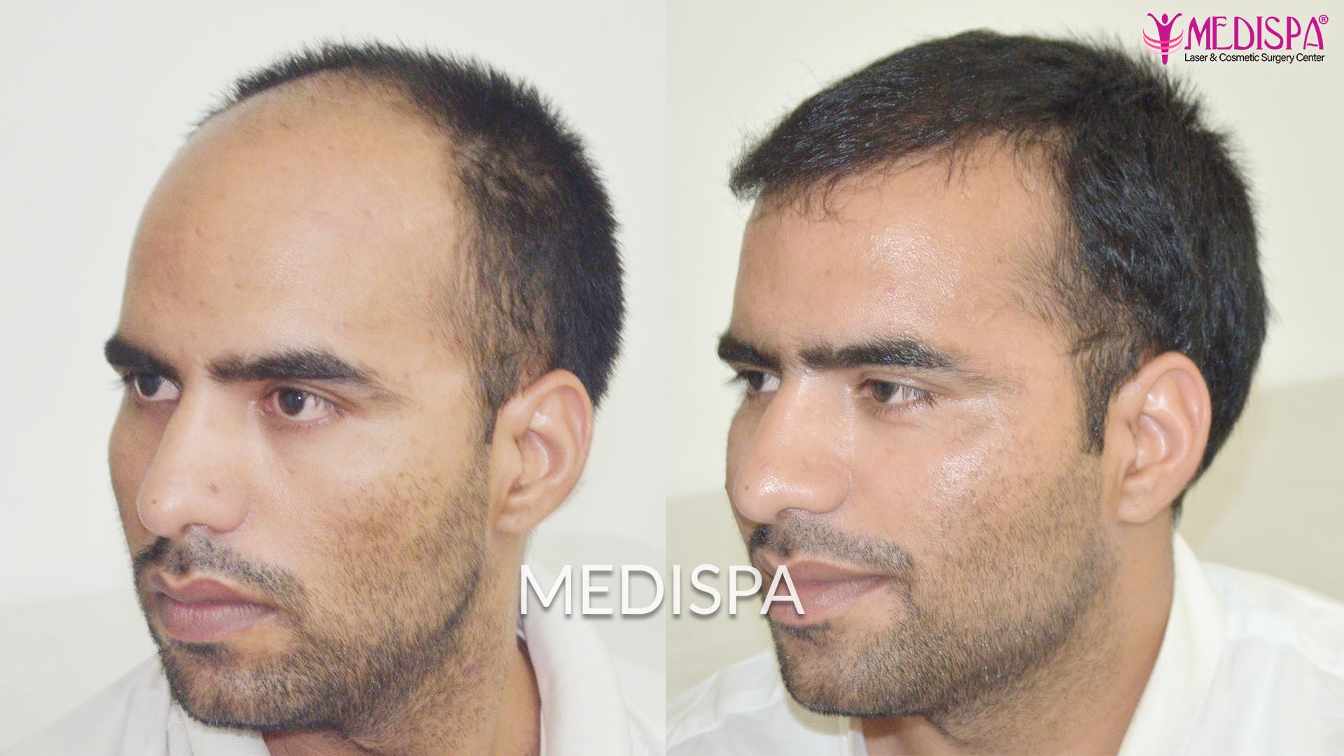 hair transplant cost in canberra