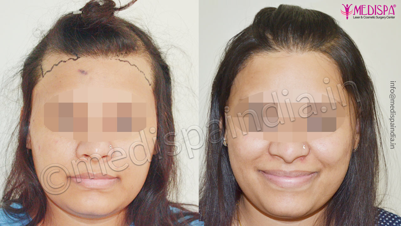 hair transplant cost in chennai india