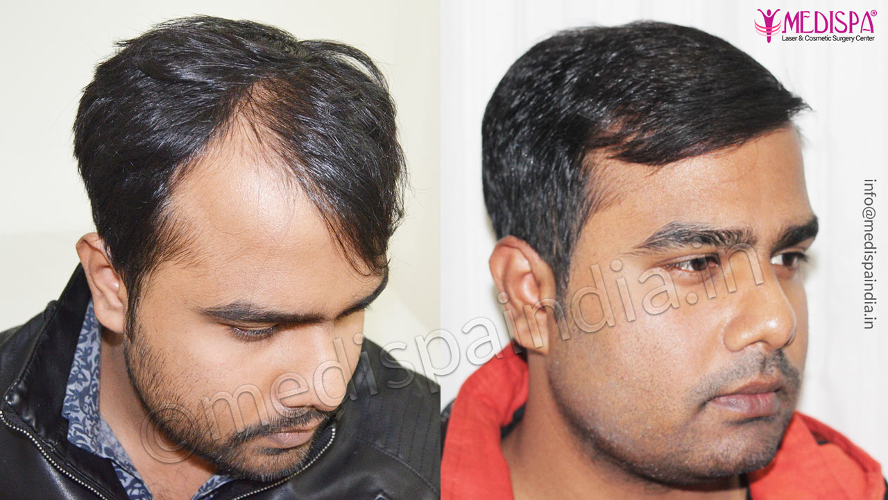 hair transplant cost in chennai