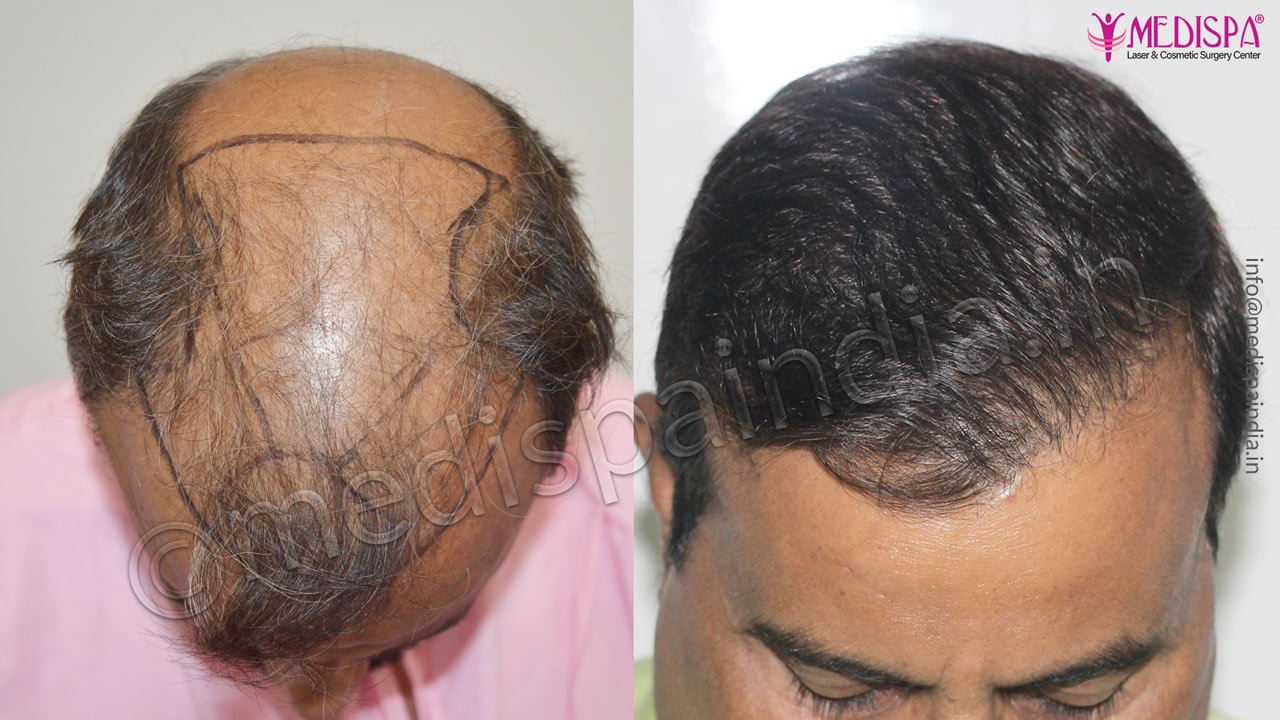 hair transplant cost in dubai