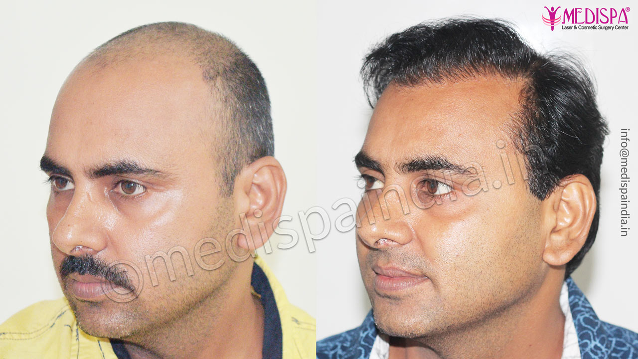 hair transplant cost in faridabad