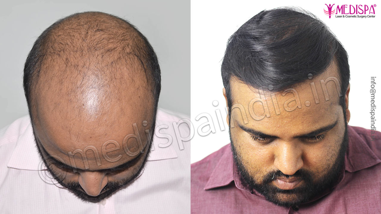 hair transplant cost in gurgaon