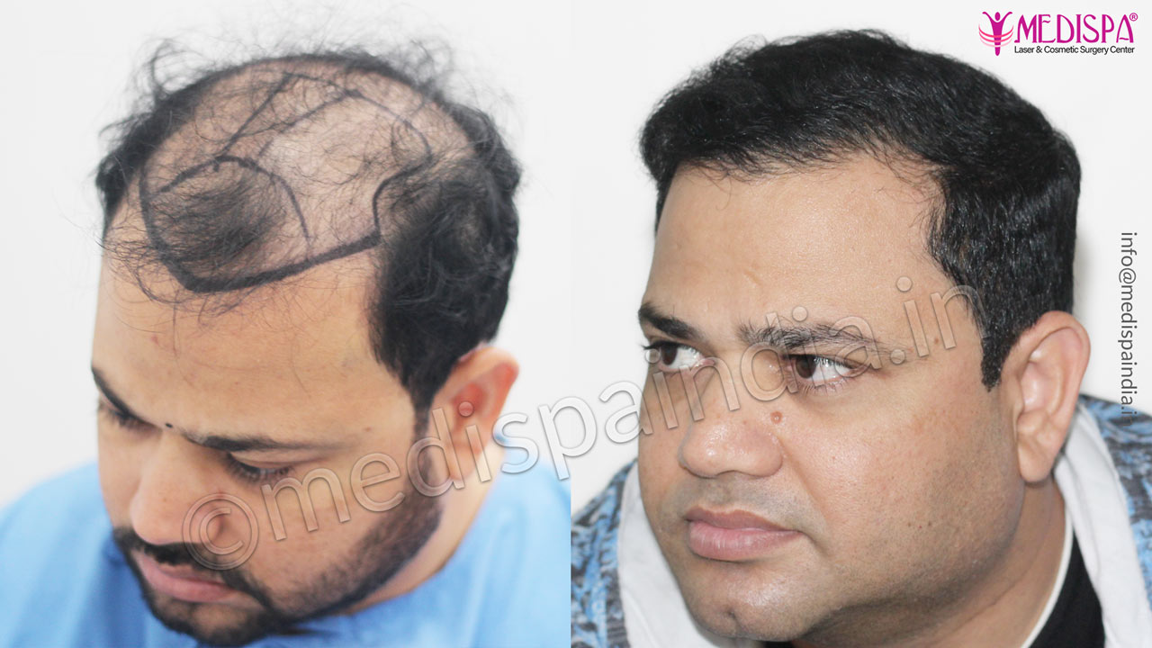 hair transplant cost in hyderabad
