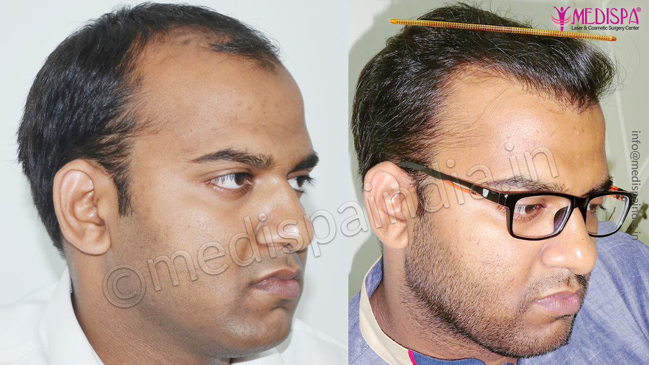 hair transplant cost in jaipur rajasthan