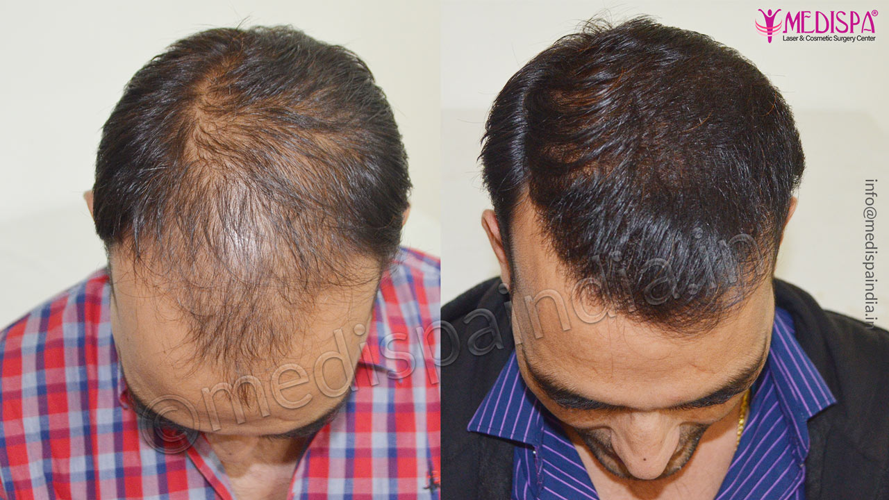 hair transplant cost in jodhpur rajasthan
