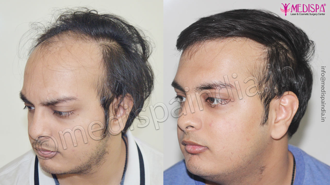 hair transplant cost in jodhpur