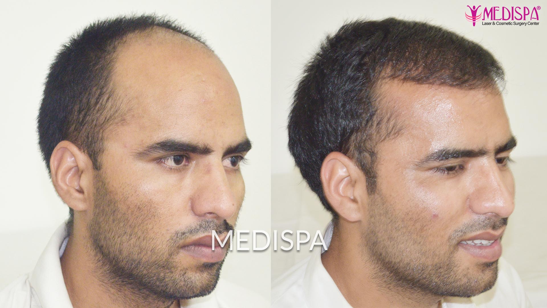 hair transplant cost in new york