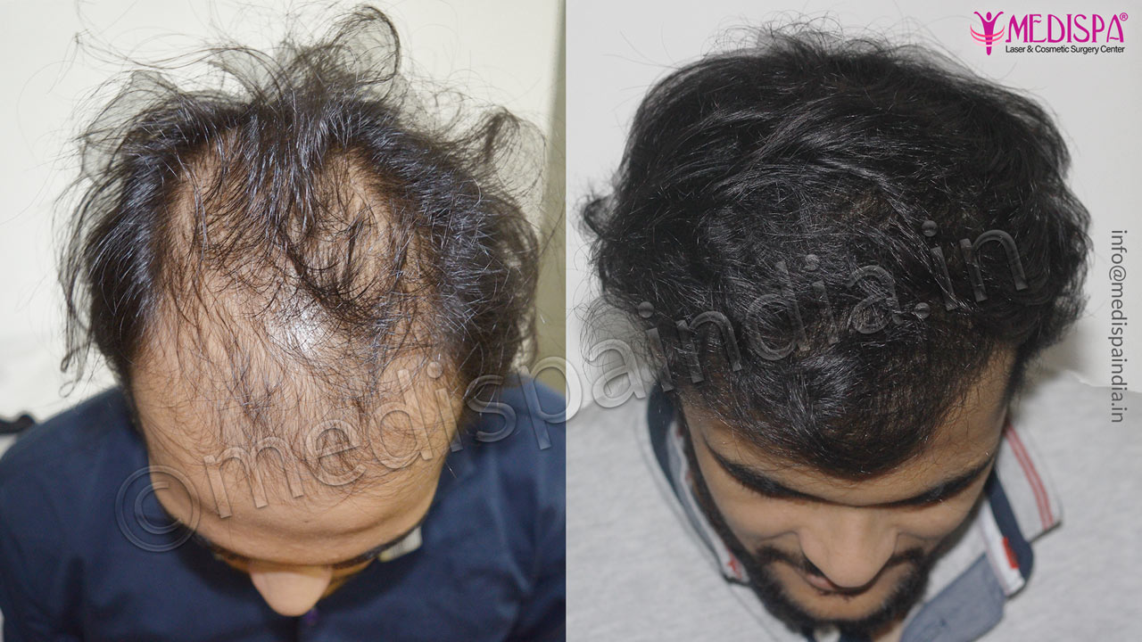 hair transplant cost in new-zealand