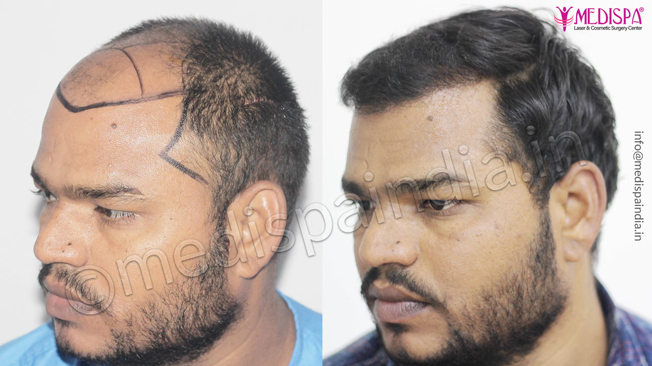 hair transplant cost in nigeria