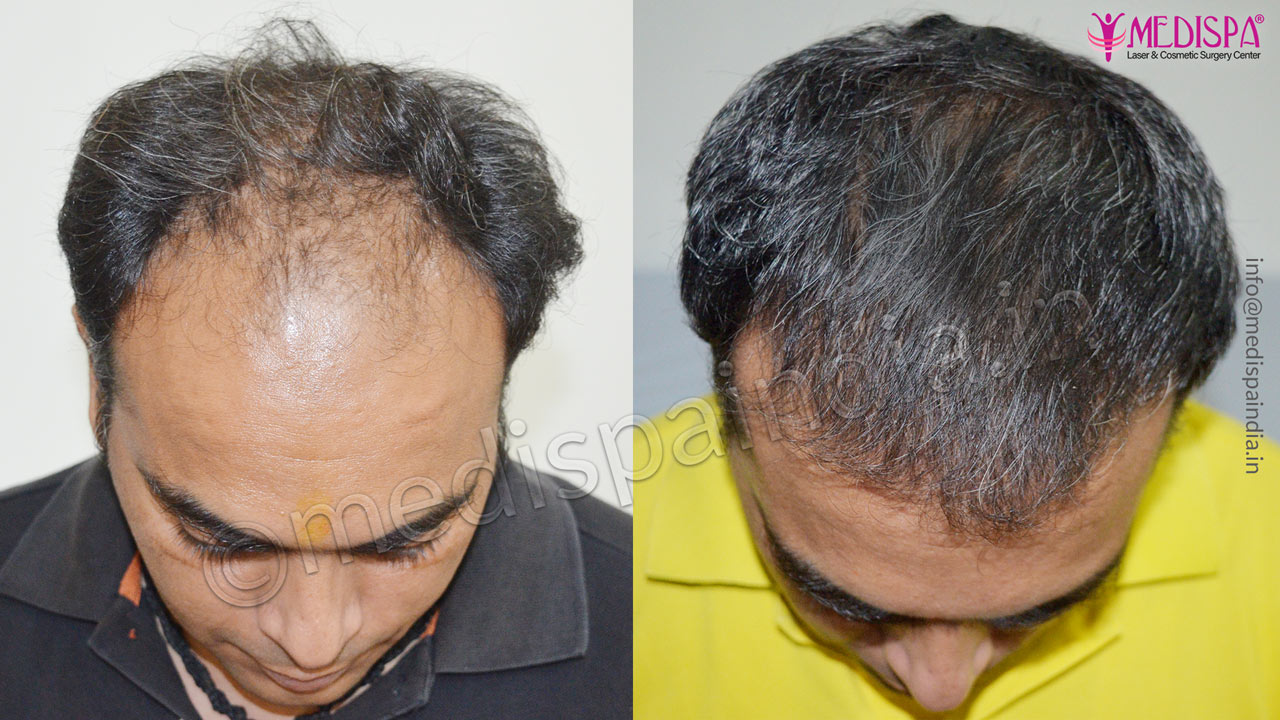 hair transplant cost in surat