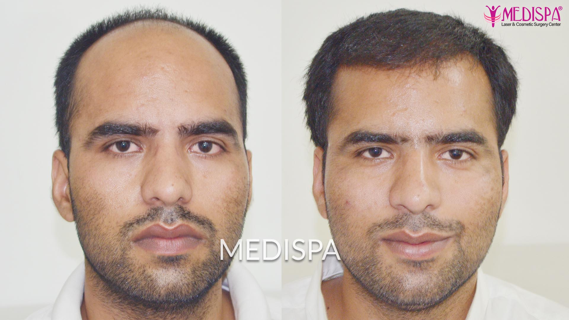 Best Hair Transplant results in Pune at Medispa India Best Hair Transplant results in Pune at Medispa India