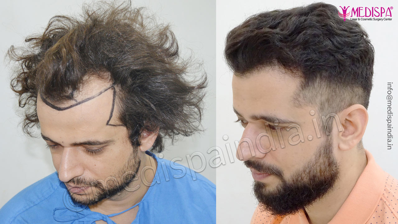 hair transplant cost in usa
