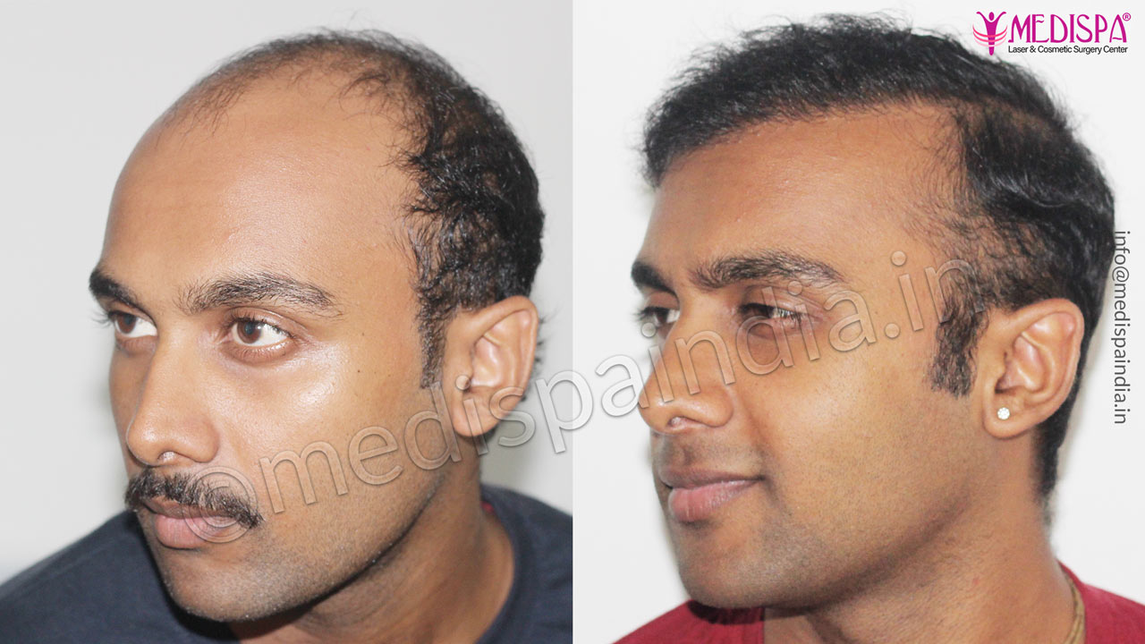 hair transplant cost india