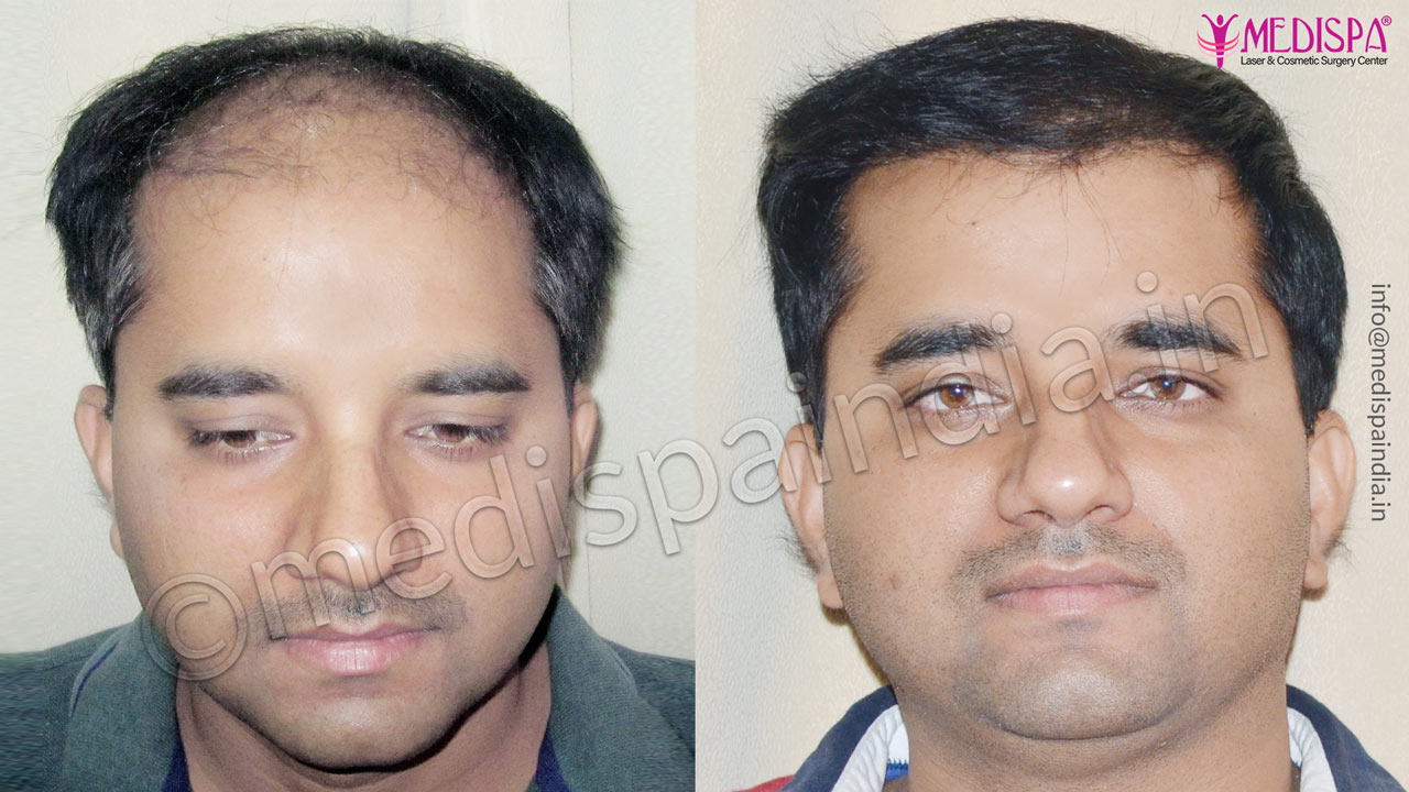 hair transplant cost nigeria