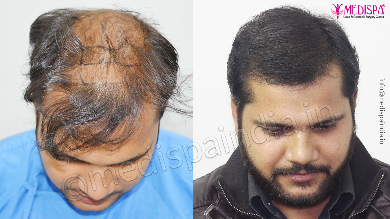 hair transplant delhi cost india