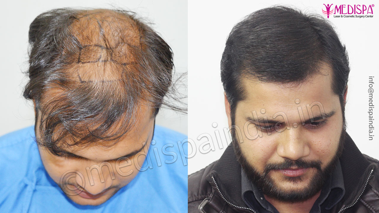 Hair Restoration Photo Gallery | Medispa Clinic India Hair Restoration Photo Gallery | Medispa Clinic India
