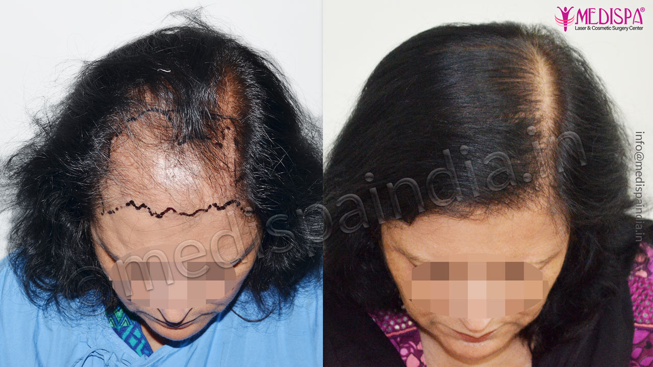 hair transplant doctors in greater kailash south delhi