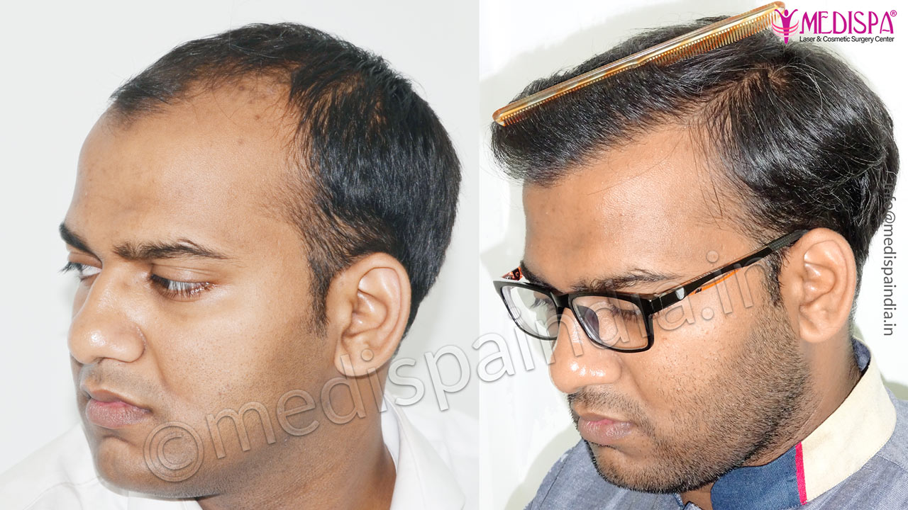 hair transplant doctors in jaipur rajasthan