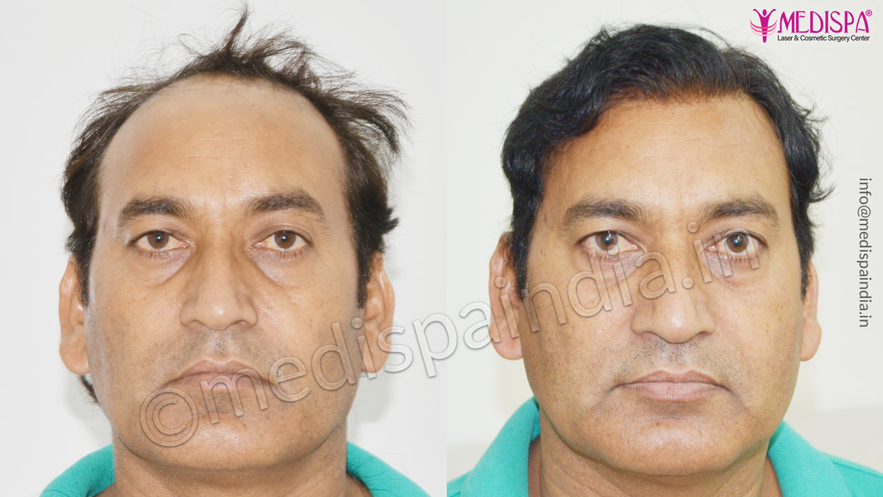 hair transplant doctors in south delhi