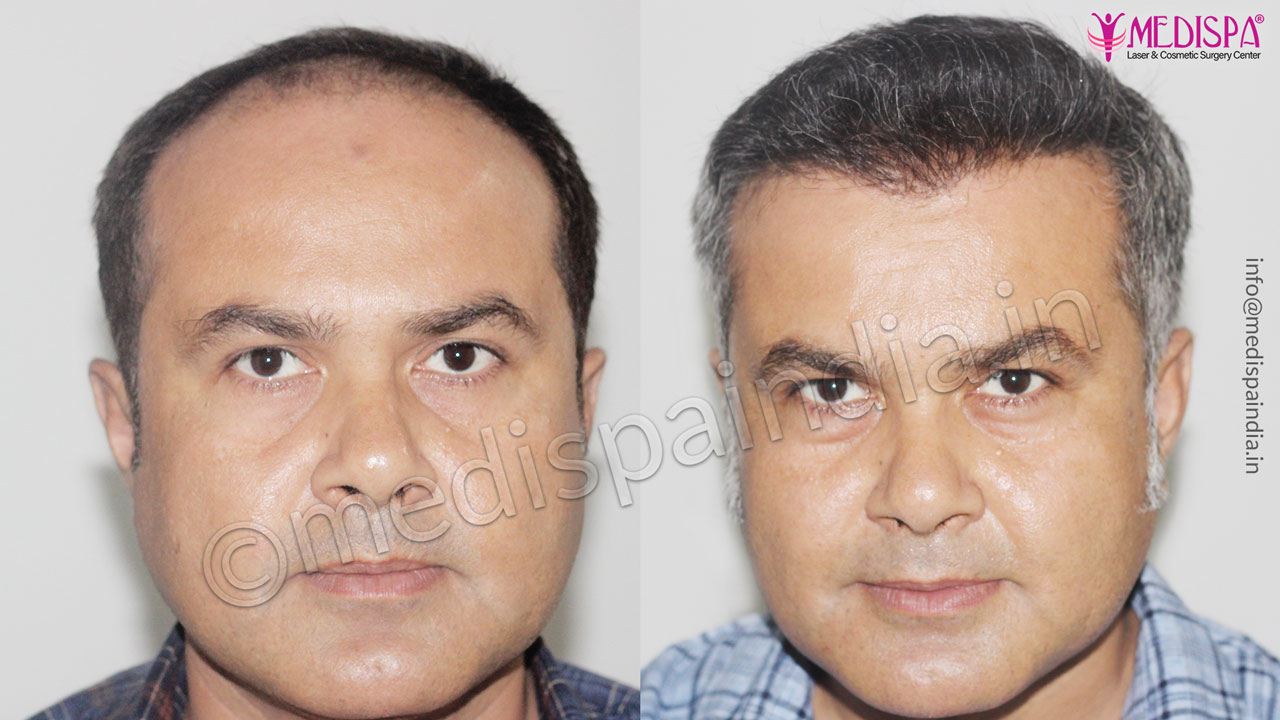 delhi hair transplant cost