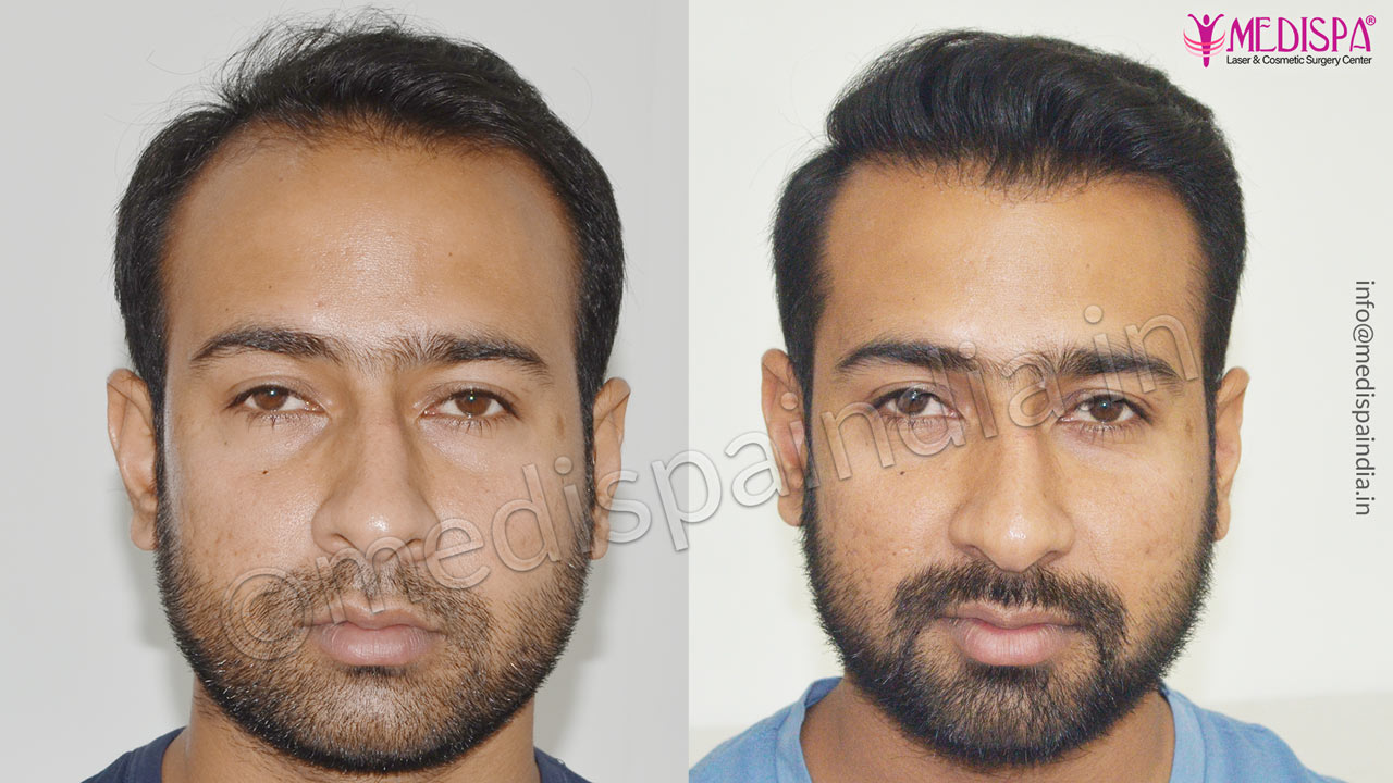 dubai hair transplant result