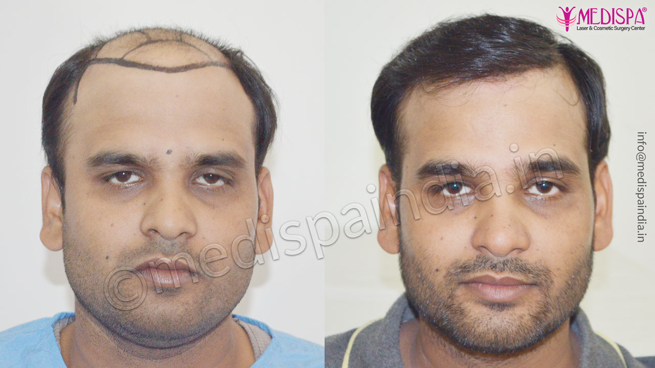 FUT Hair Transplant Results in Ahmedabad | Medispa India