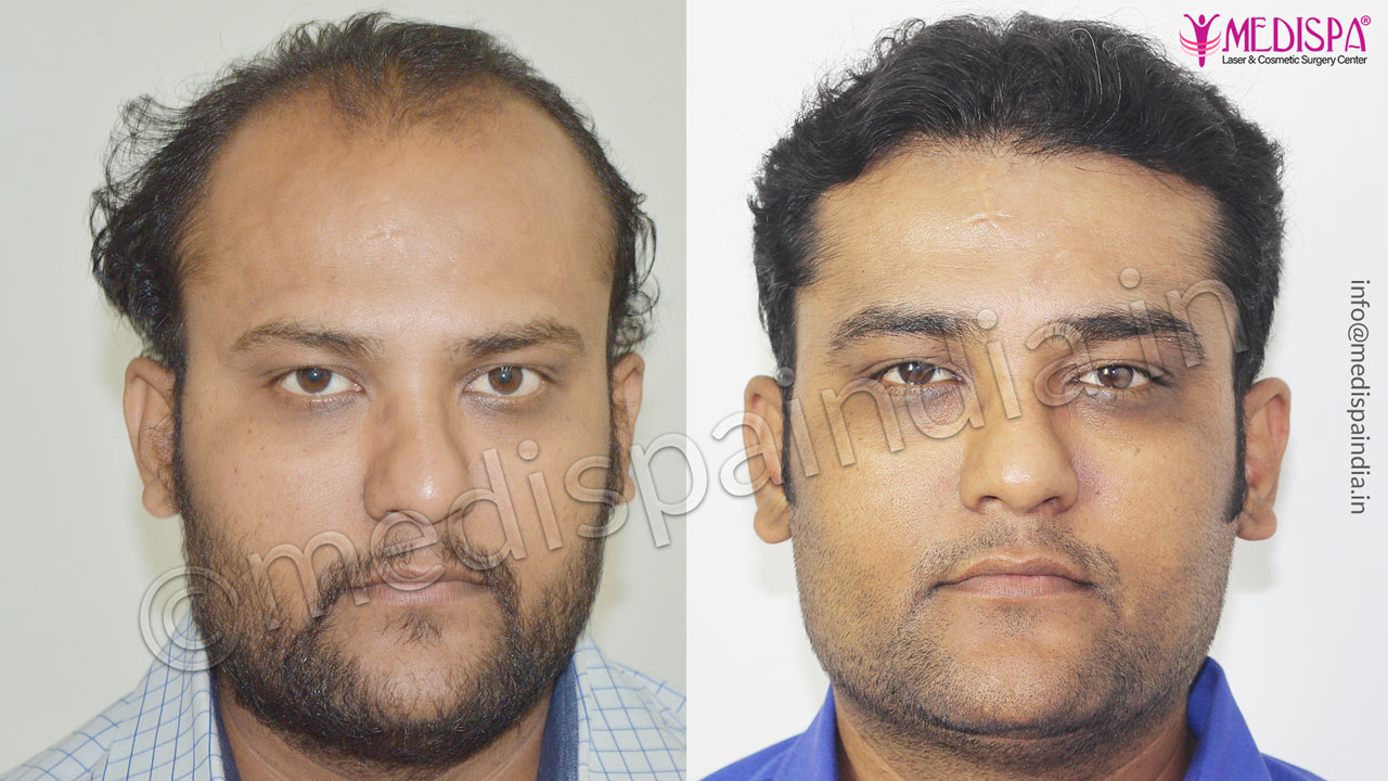 hair transplant in bangladesh