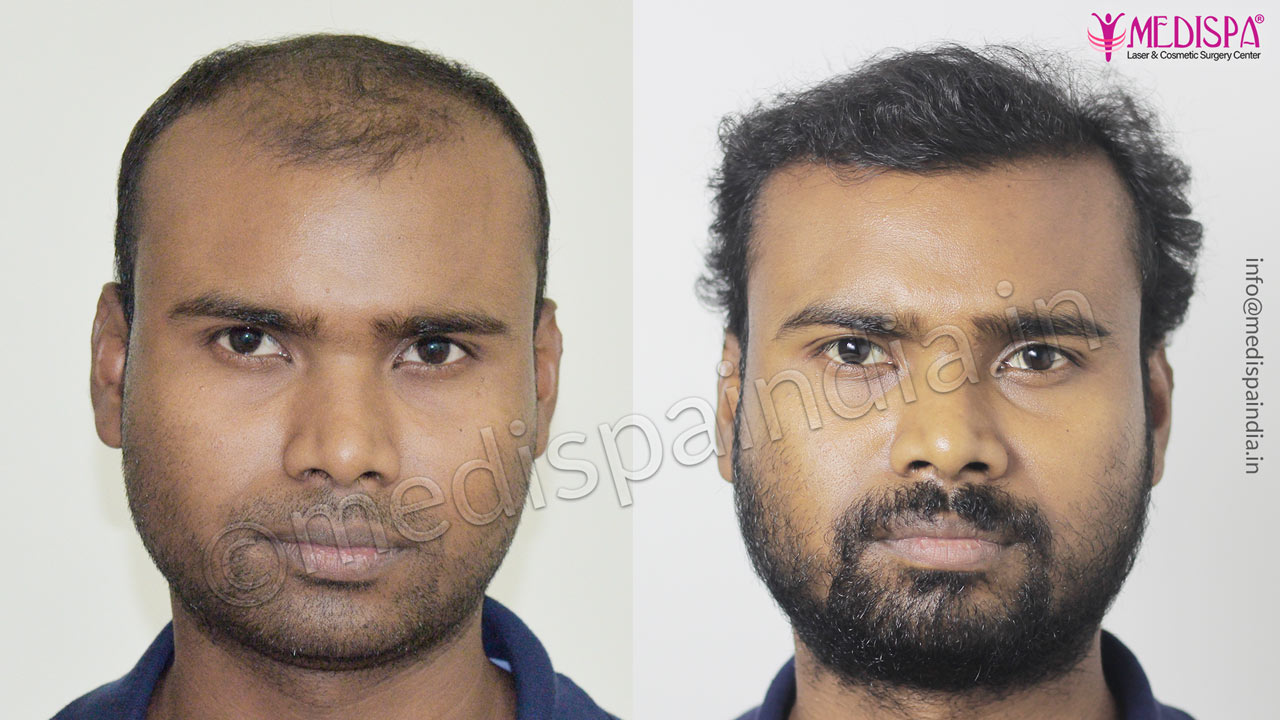 hair transplant in bengaluru