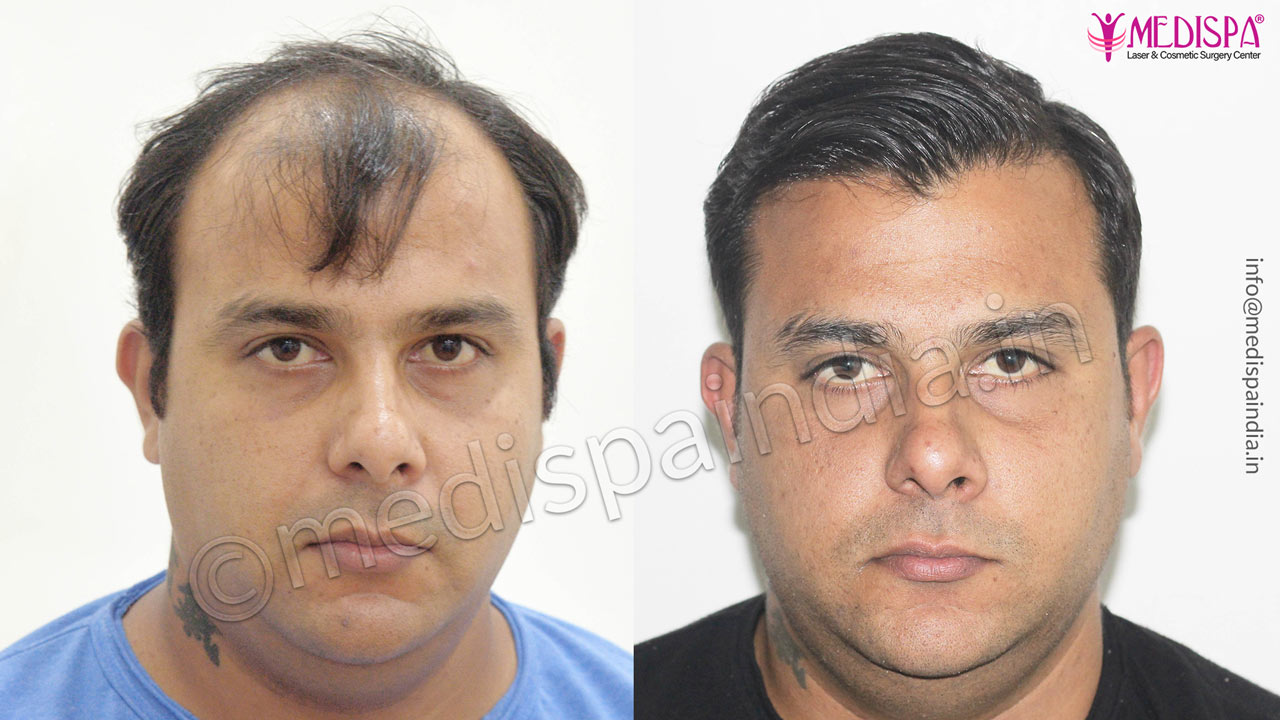 hair transplant in bhubhneshwar