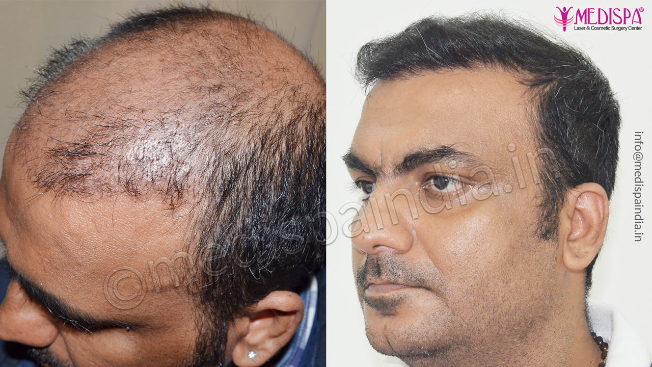 hair transplant in bikaner