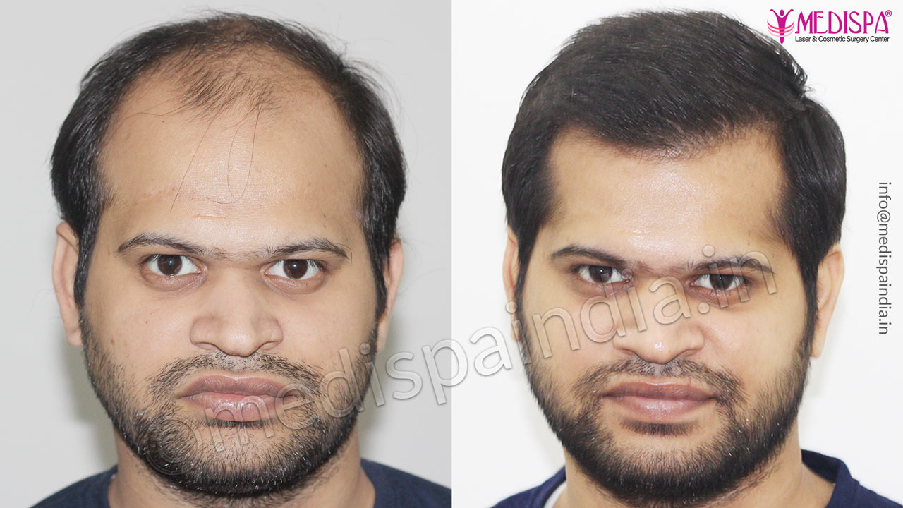 India hair transplant result
