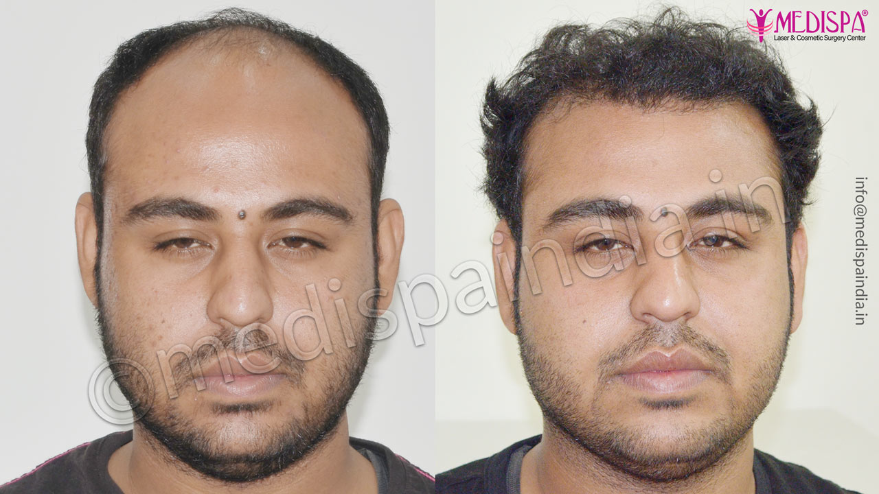 hair transplant in dehradun