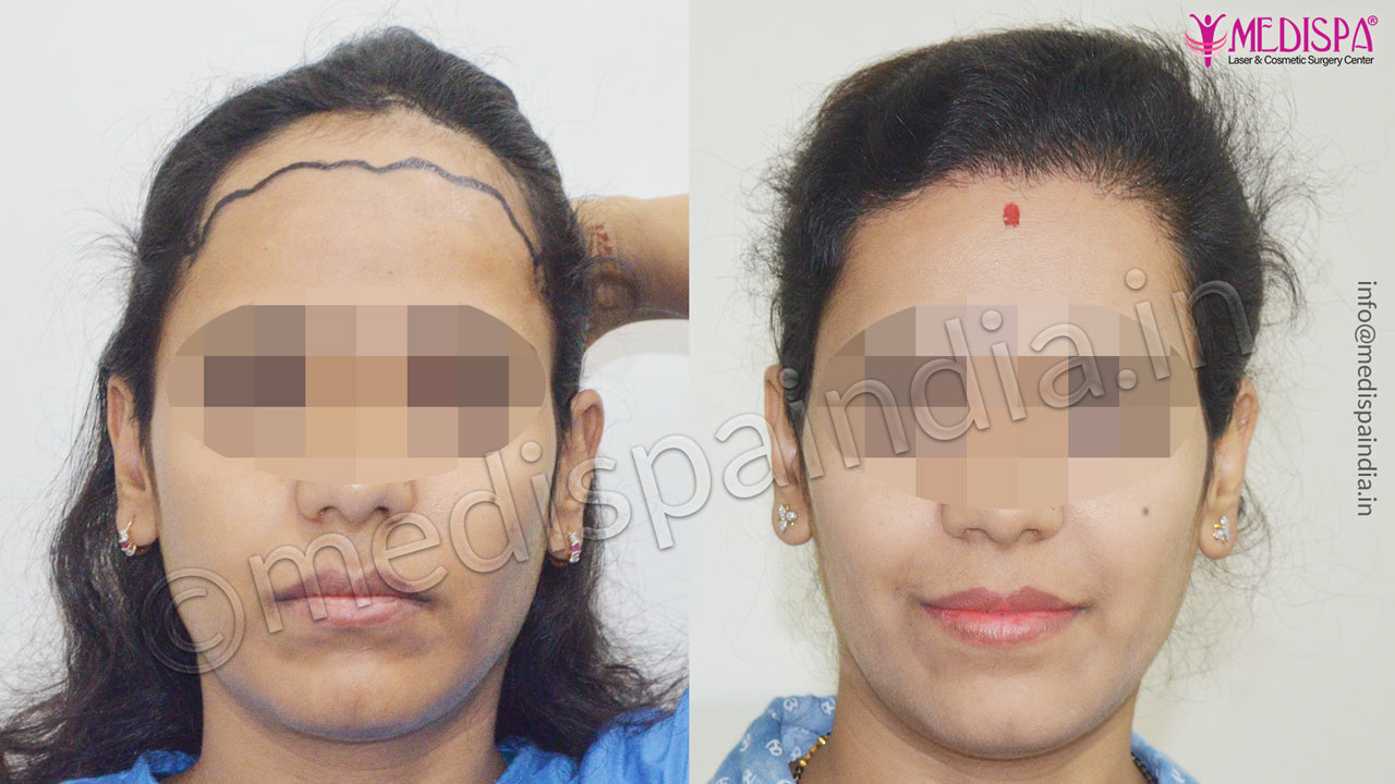 hair transplant in delhi cost