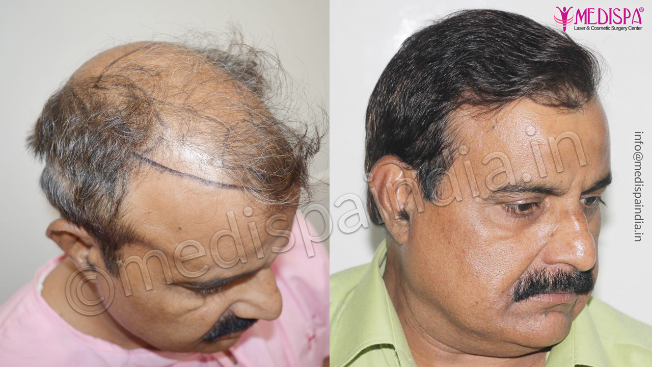 Male Hair Transplant  Maxim Clinic