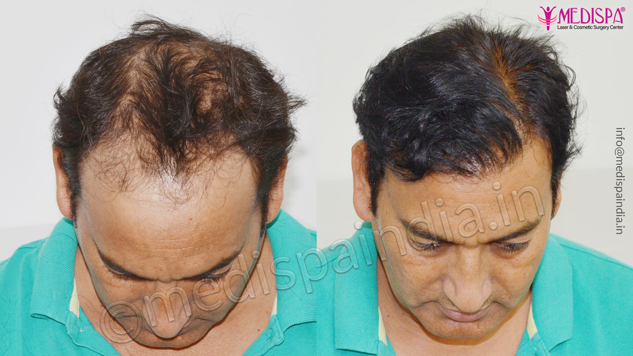 hair transplant in greater kailash