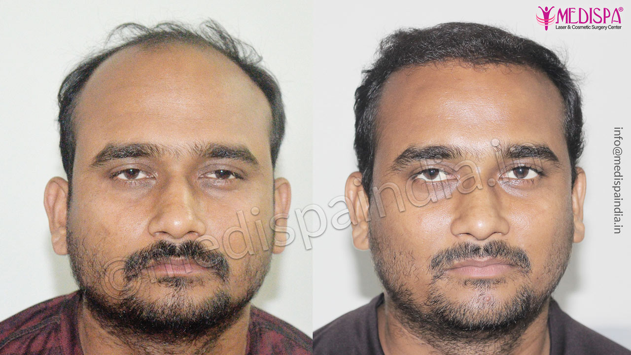 hair transplant in gujarat india