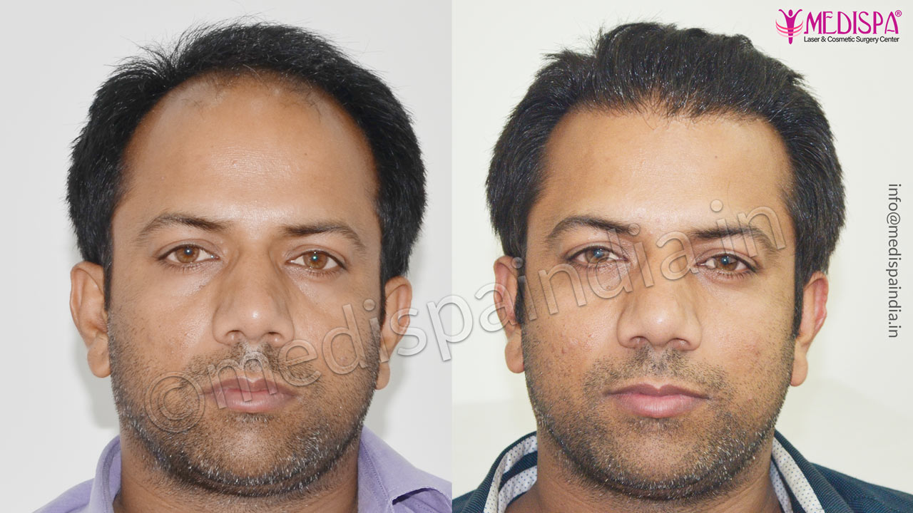 hair transplant in gurugram