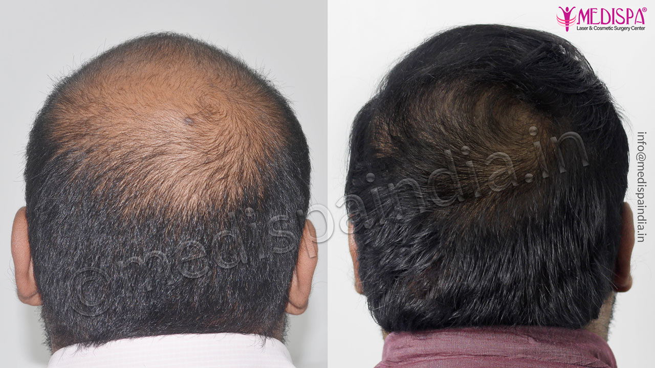 hair transplant in gurugram