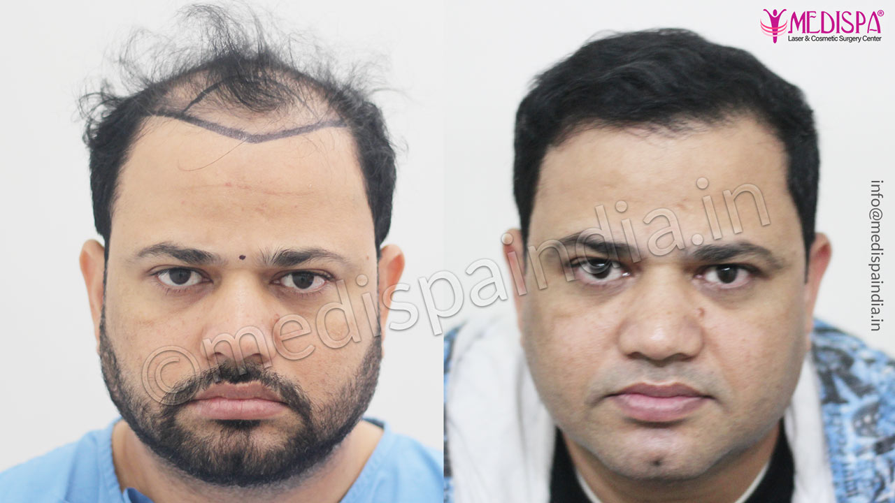 hair transplant cost in india