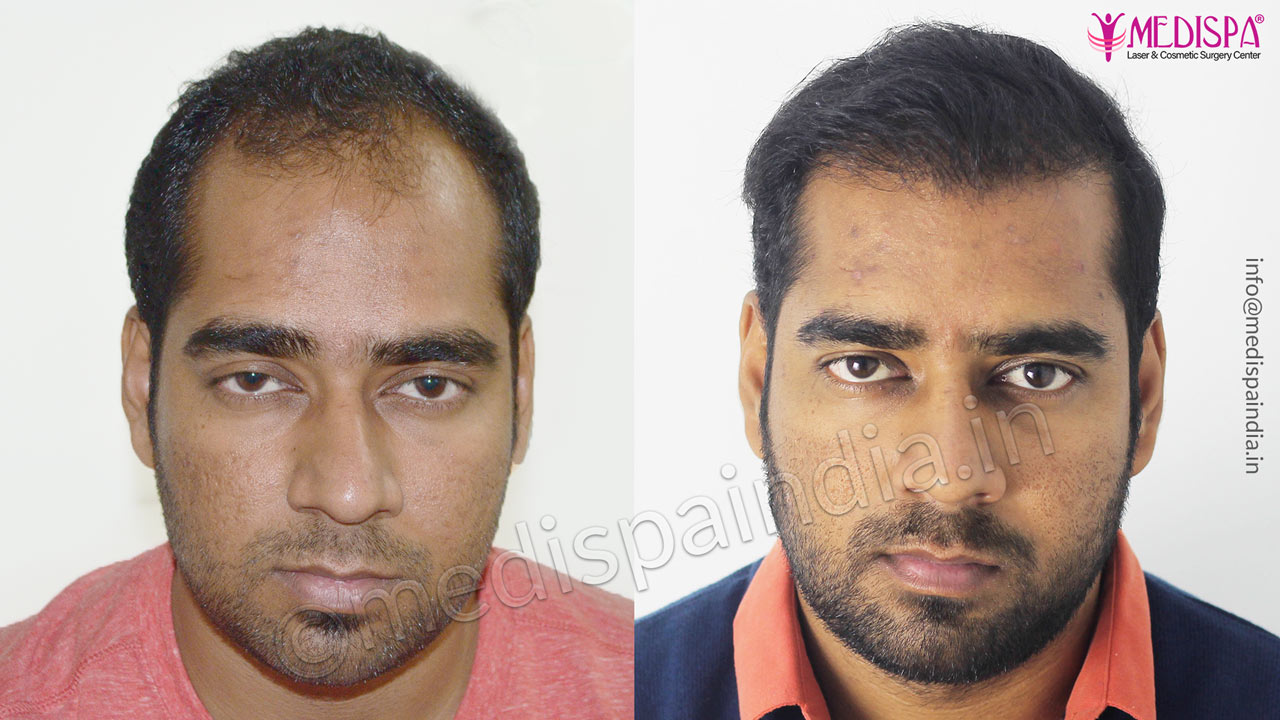 hair transplant in india cost
