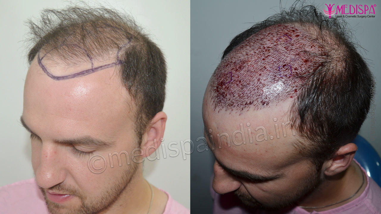 hair transplant in ireland