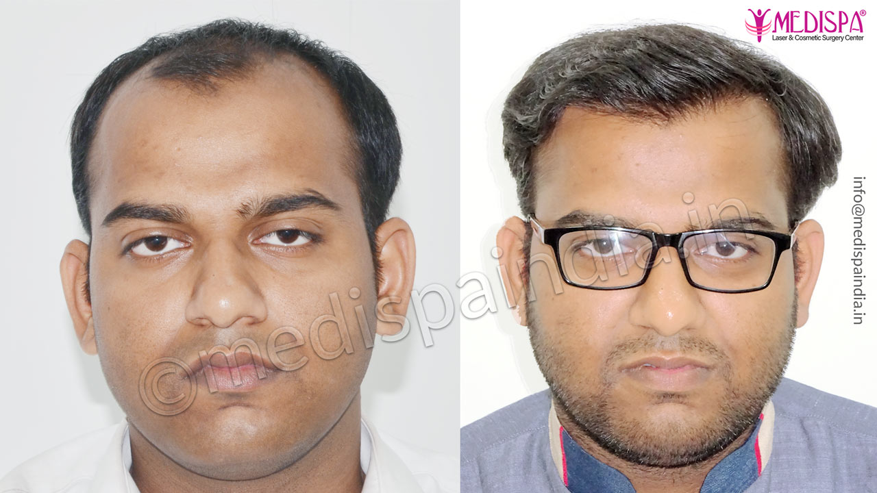 Best FUT Hair Transplant Before After Results Jaipur India Best FUT Hair Transplant Before After Results Jaipur India