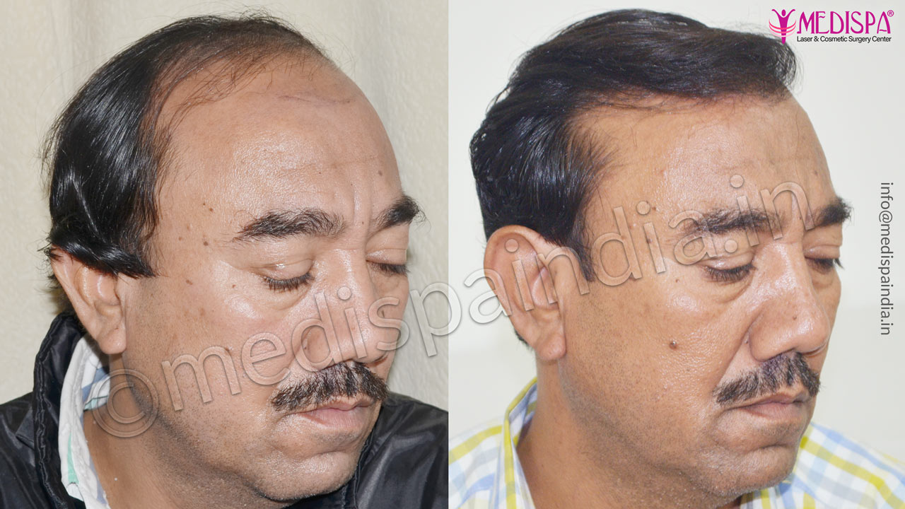 hair transplant in jammu and kashmir