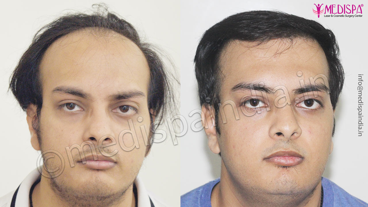 hair transplant in jodhpur